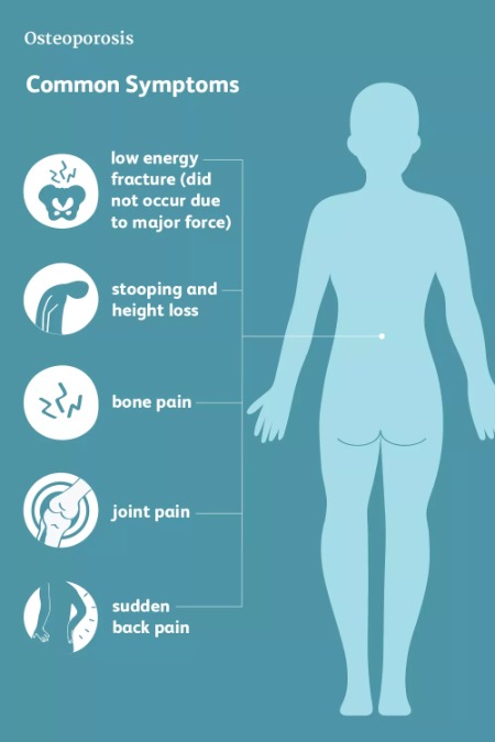 osteoporosis-image